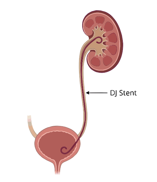 DJ stent inside kidney and bladder